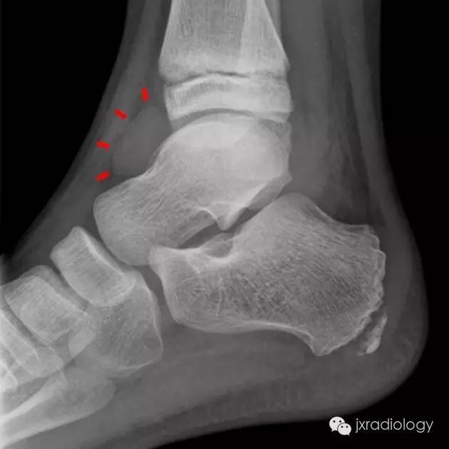 外伤病人看到“泪滴征”一定要想到骨折YXZX101：-MedSci.cn