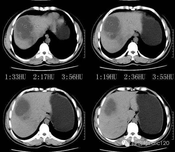 肝脓肿--CT病例图片影像诊断分析