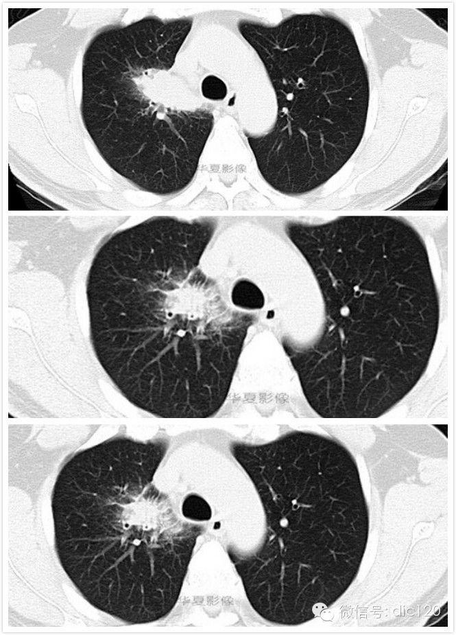 <font color="red">华夏</font>病例--不典型肺结核并感染CT影像表现