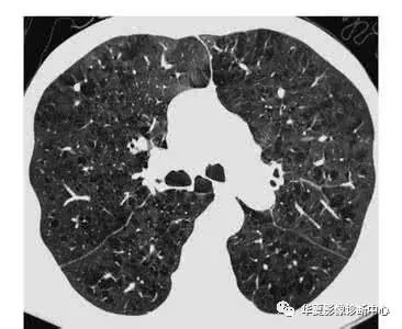 【影像基础】肺气肿、肺大泡、肺气囊有什么不一样？