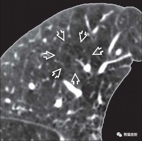 肺气肿，小叶中央型丨CT表现、诊断要点