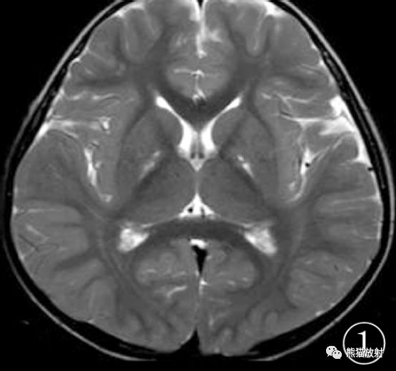 Leigh综合征丨脑MRI表现、诊断及鉴别诊断