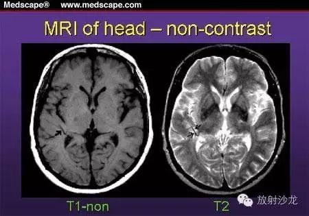 急性脑梗塞的MRI诊断