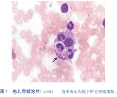 【PHILIPS每日一例】蓝氏贾第鞭毛虫合并EB病毒相关性噬血细胞综合征1例
