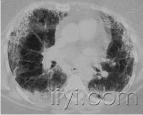 肺部CT征象