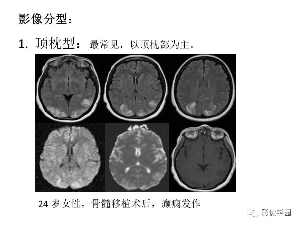 [影像笔记] 可逆性后部脑病综合征（PRES）