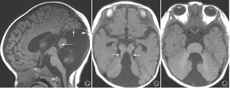 Dandy Walker畸形合并“臼齿”征畸形的MRI表现2例