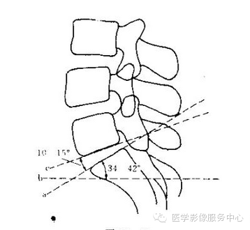 图解骶椎腰化、<font color="red">腰椎</font>骶化、<font color="red">腰椎</font>滑脱