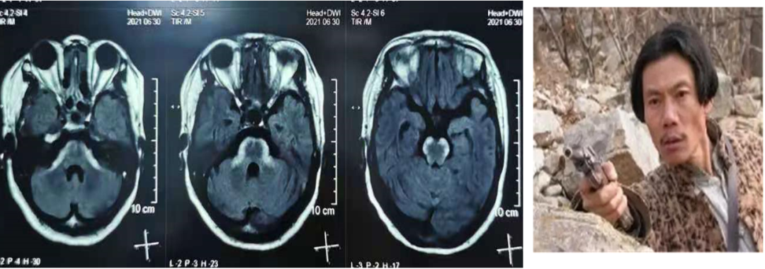 脑MRI见到“汉奸头”征？影像表现