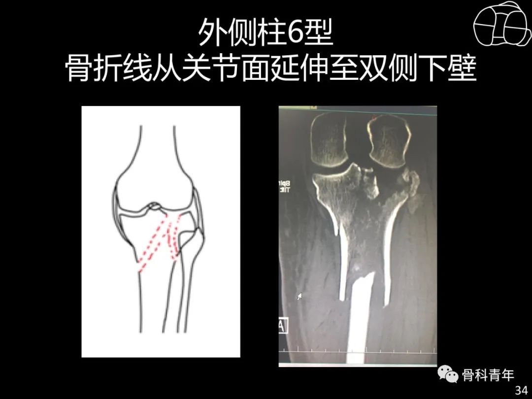 胫骨平台骨折“四柱九区分型”理论介绍@MedSci