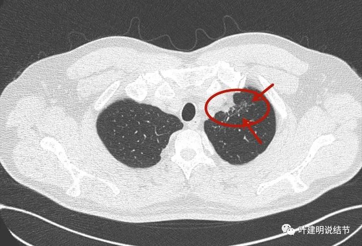 问诊分析：肺部这种病灶最难定到底良性还是恶性，这时候怎么办？