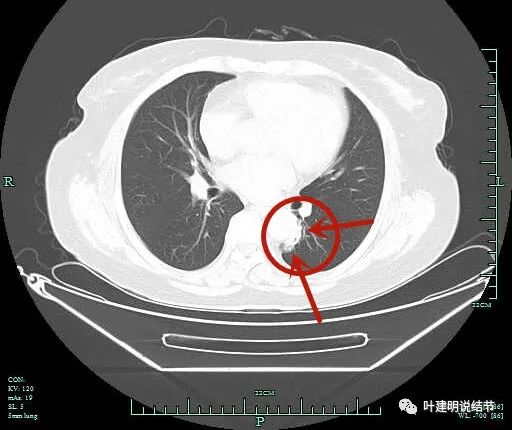 病例<font color="red">AB</font>选（2022.10.13）：这样的肺占位到底是良性还是恶性？