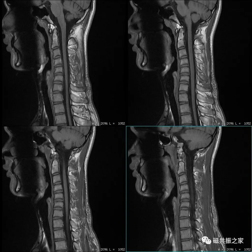 掌握了这些，<font color="red">脊柱</font><font color="red">MRI</font>想做不好都难！