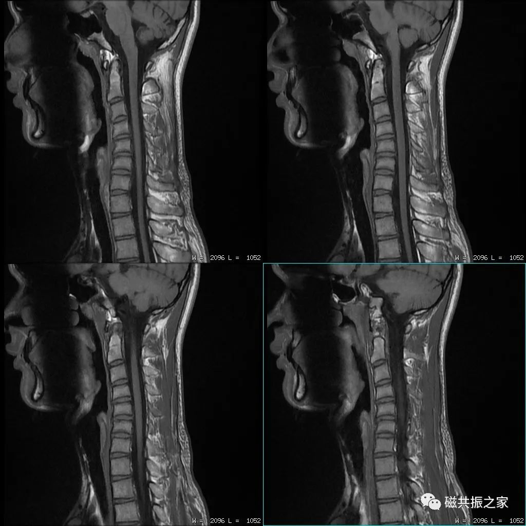 掌握了这些，脊柱MRI想做不好都难！