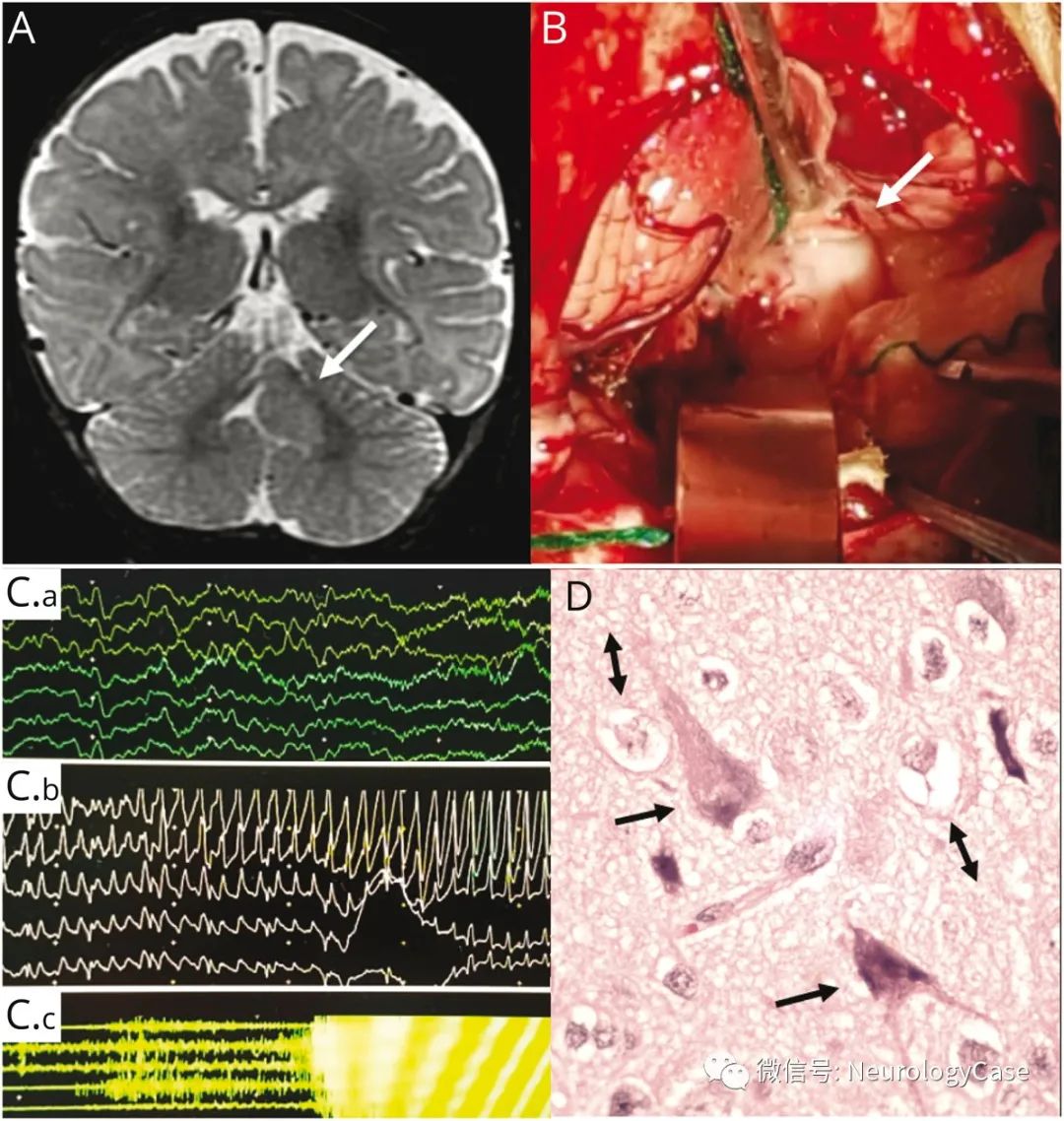 Neurology病例：与新生儿<font color="red">小脑</font>癫痫相关的连续<font color="red">单</font><font color="red">侧</font>眨眼