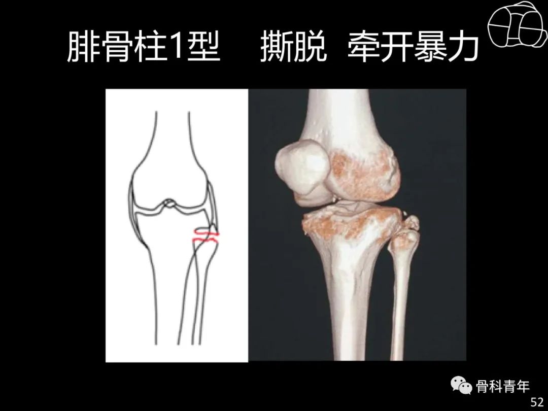 胫骨平台骨折“四柱九区分型”理论介绍@MedSci