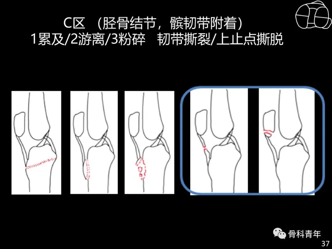 胫骨平台骨折“四柱九区分型”理论介绍@MedSci