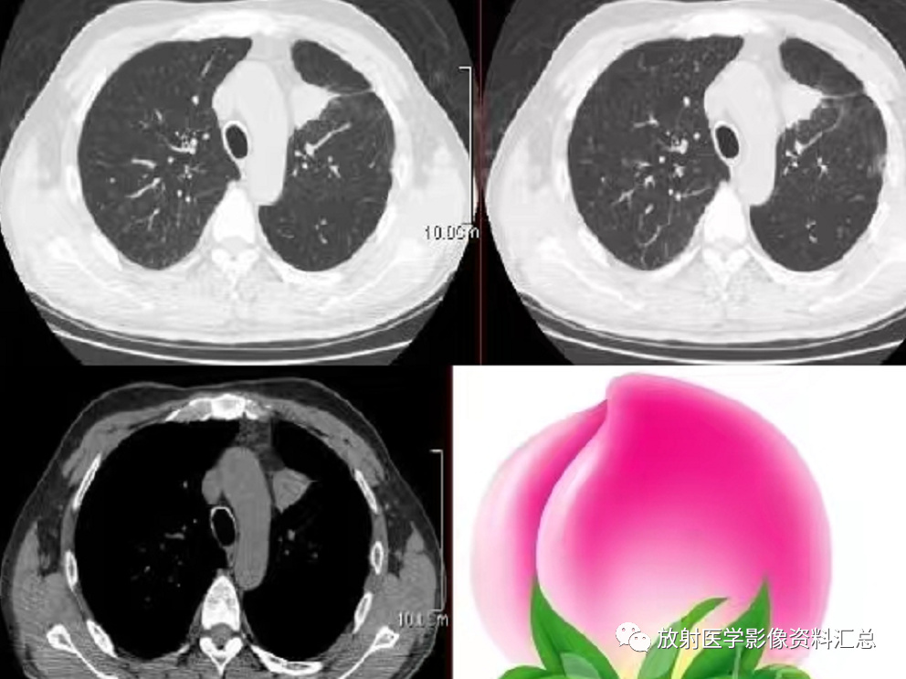 肺部“<font color="red">桃</font>尖征” 的影像表现与临床意义