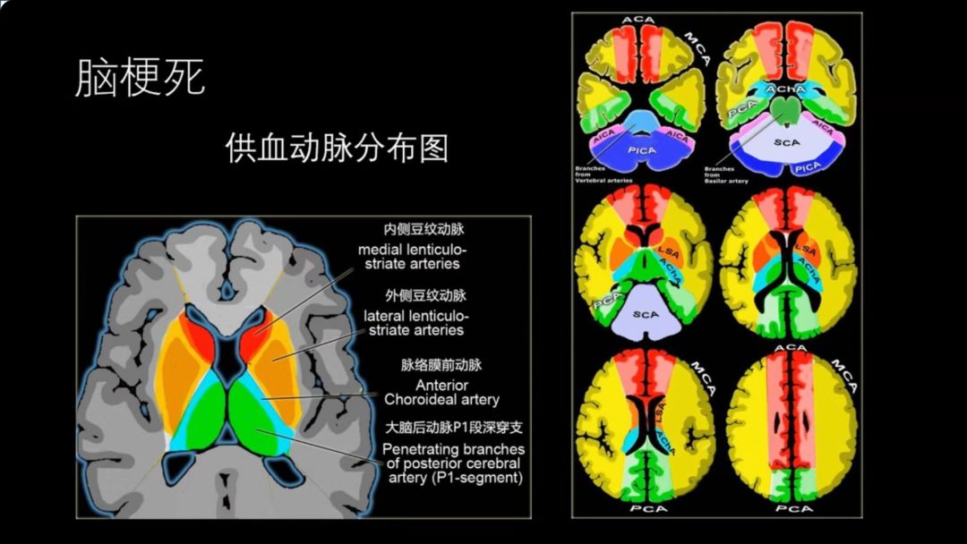 【推荐】常见脑<font color="red">血管</font>疾病的MRI表现