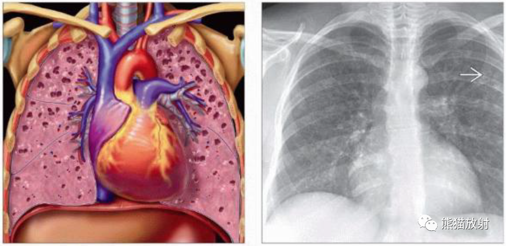 肺朗格汉斯组织细胞增多症丨影像表现