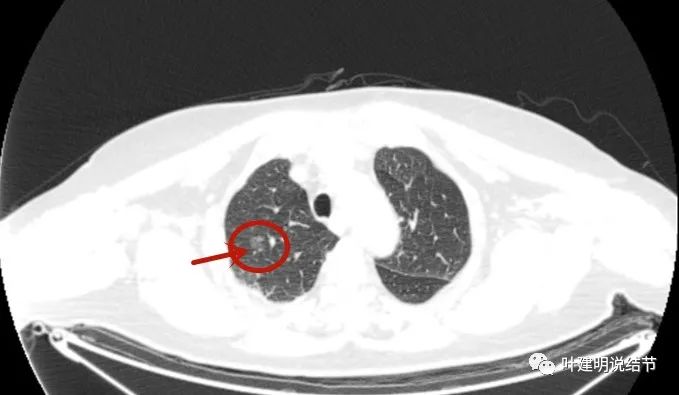 问诊分析（2022.11.1）：磨玻璃结节术后半年发现广泛转移？CT与PET都这么说！