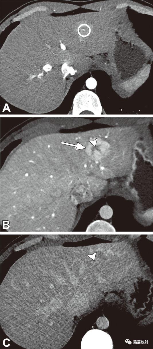 FNH及FNH<font color="red">样</font><font color="red">病变</font>丨影像表现