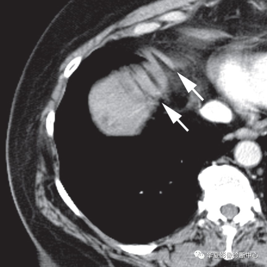 外伤急诊影像，看到这个结构不要误诊为肝脏损伤