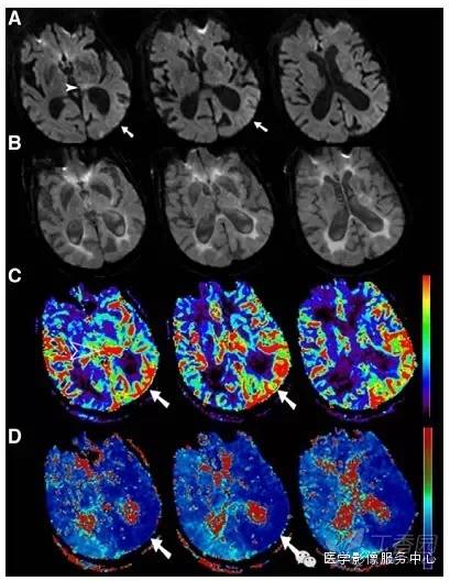 6 分钟 <font color="red">MRI</font> 流程评估急性缺血性脑卒中