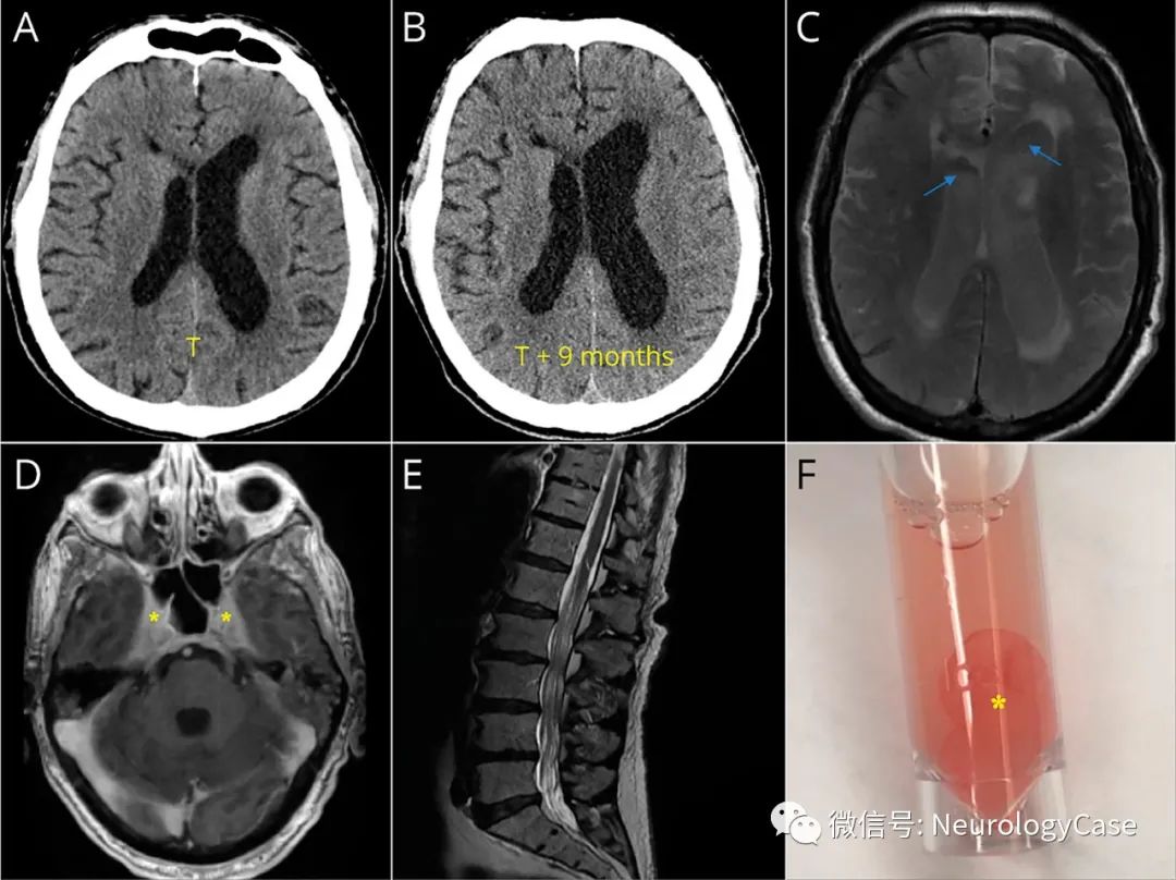 Neurology病例：Bing-Neel综合征：继发性正常压力<font color="red">脑积水</font>的罕见模仿者