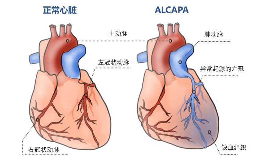 Eur J Cardiothorac Surg：张海波教授团队发布左冠状动脉异常起源于肺动脉（ALCAPA）手术中的二尖瓣处理成果
