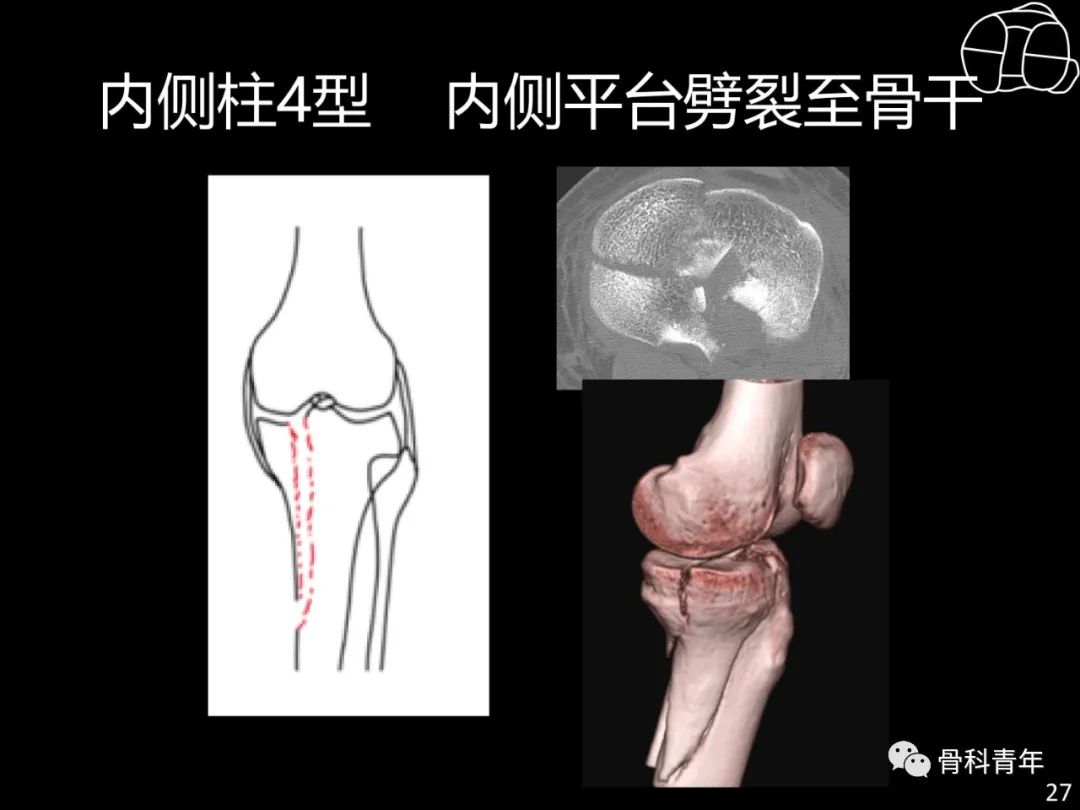 胫骨平台骨折“四柱九区分型”理论介绍@MedSci