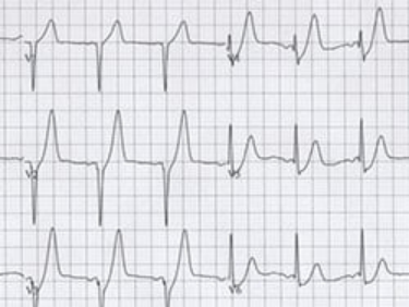 看到这些心电图，应行<font color="red">紧急</font>冠脉造影！“与STEMI同等危险的心电图表现”