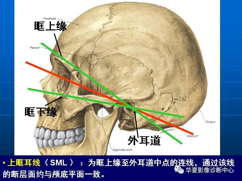 头颅CT基本知识及常见疾病