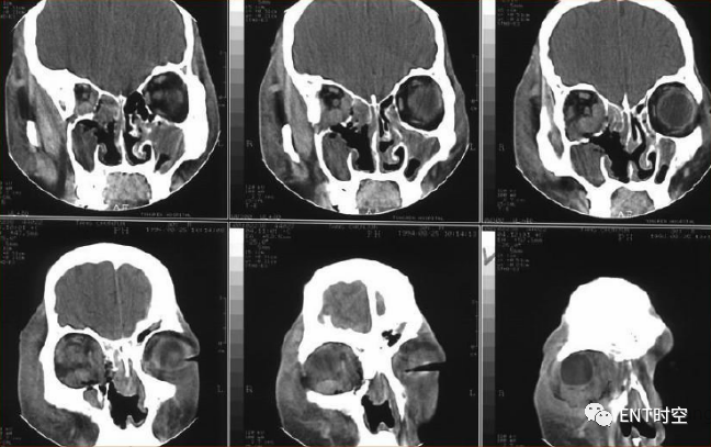 CT片，带你看鼻窦炎的影像诊断及15种相关病变！