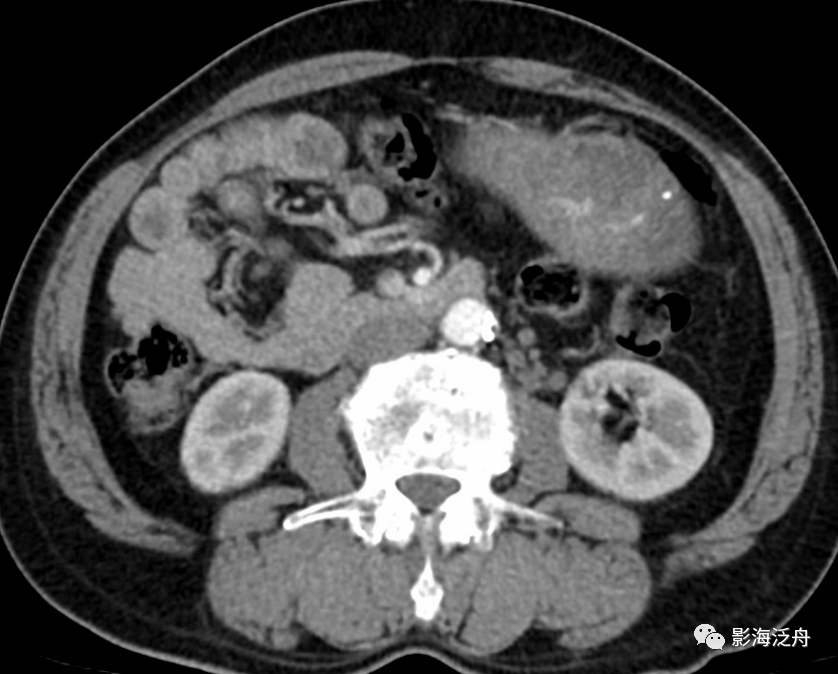 这个腹部CT你可能经常漏诊！