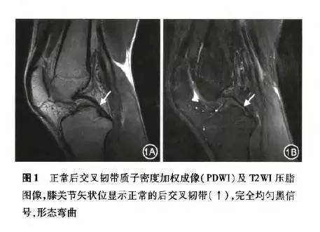 膝关节韧带正常解剖与损伤<font color="red">的</font> MRI 表现