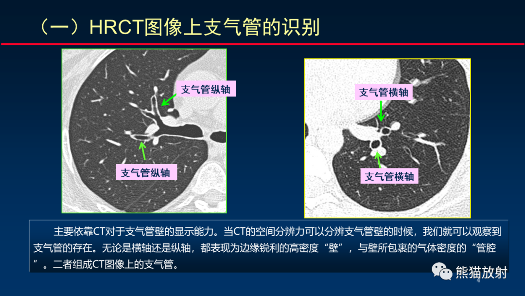 柳澄讲坛丨HRCT对肺结核细节的观察进展