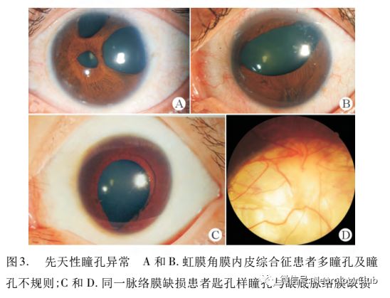 专家述评：瞳孔异常的评估及病因分析