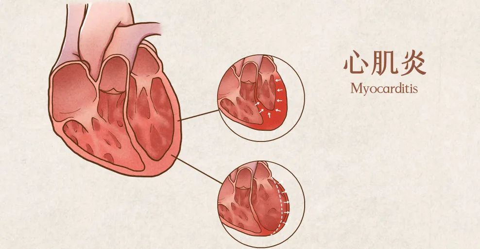 COVID-19是如何引起心肌损伤，又是如何进展为心肌炎的？