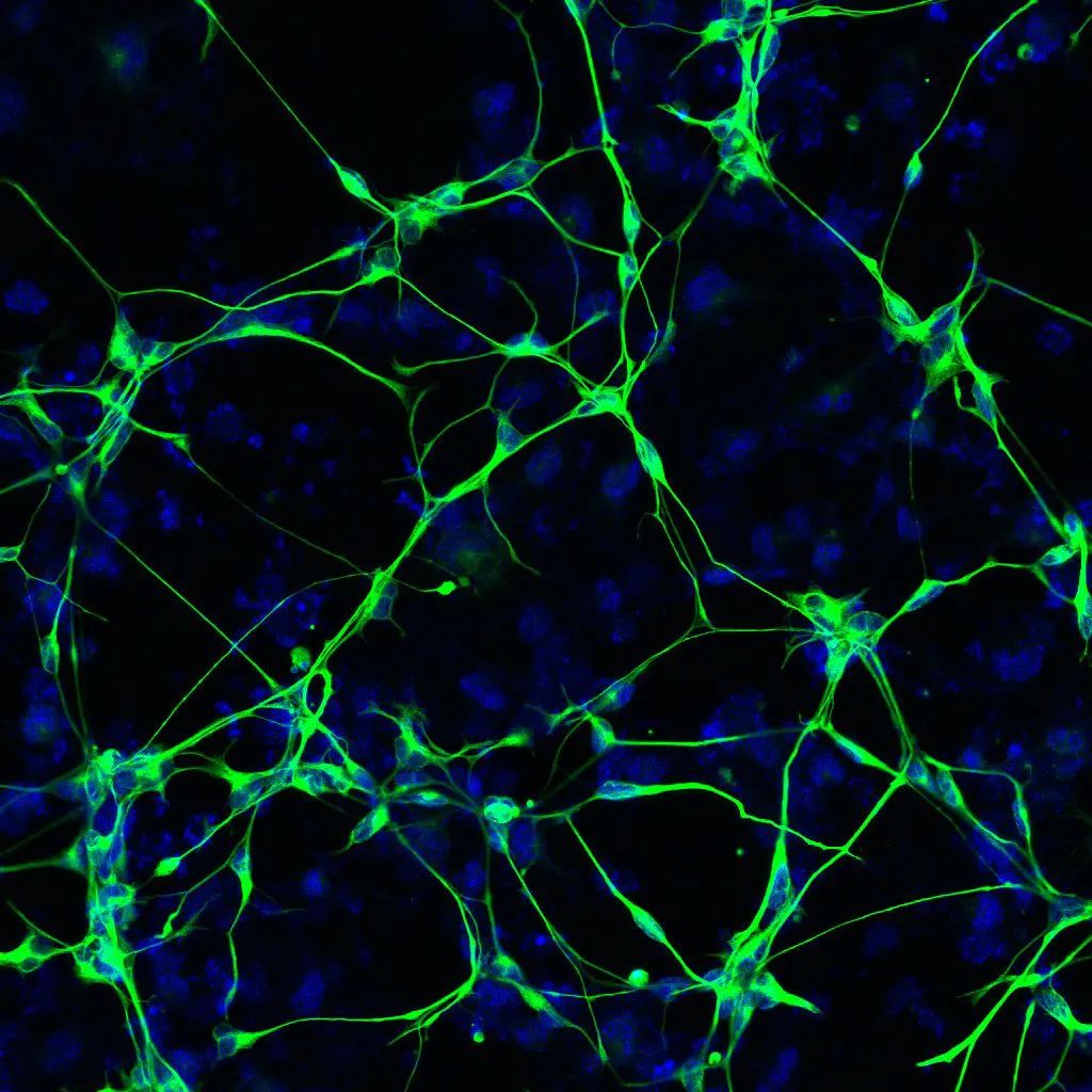 退化的神经元是阿尔茨海默病患者脑部炎症的根源