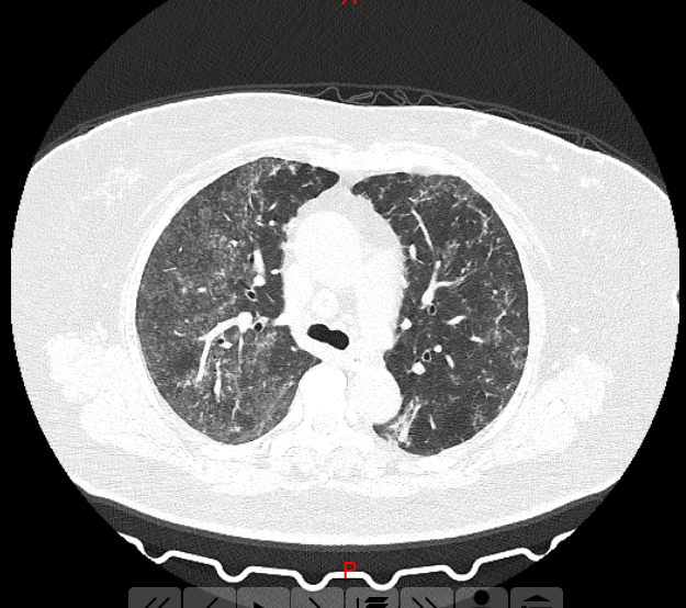 新冠疫情的“大白肺”！很可能不是新冠引发，却和新冠有关！