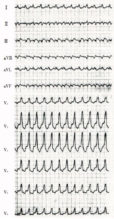 <font color="red">1</font>例室速患者的心电图特征