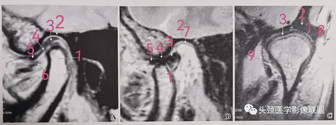 颞下颌关节解剖、正常<font color="red">MRI</font>表现