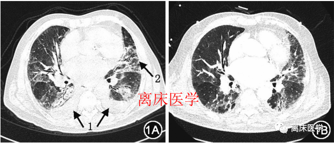 胸部CT：是肺水肿，还是新冠肺炎？如何处理？