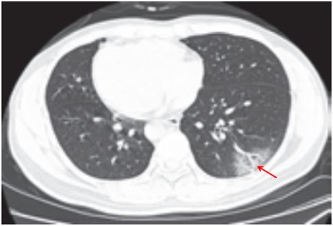 新冠肺炎CT早期征象与鉴别诊断