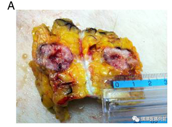 妇科恶性肿瘤腹腔镜手术穿刺孔部位转移（<font color="red">PSM</font>）的发生机制和预防措施