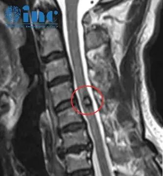 手臂麻木竟是脊髓髓内海绵状血管瘤作祟，埋在脊髓内的不定时炸弹该如何治疗？