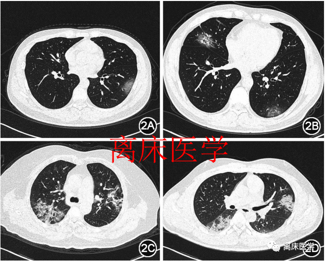 胸部CT：是肺水肿，还是新冠肺炎？
