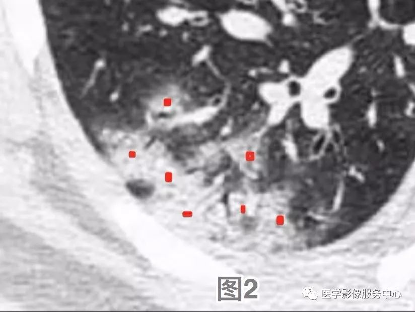 210例病例精粹丨新冠肺炎的影像解剖、病理及<font color="red">CT</font>特征