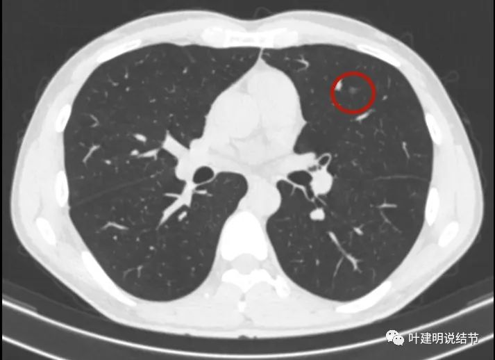 问诊分析检查发现6年了的肺磨玻璃结节，该开刀了没有，主要基于什么因素来定？
